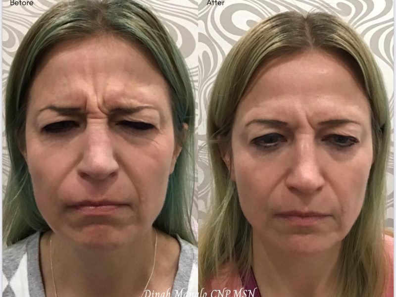 Botox for a More Youthful and Refreshed Look